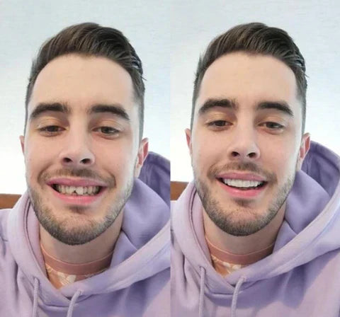 Riafu – Snap-On Veneers Set for Upper & Lower Teeth with Custom Fit | Removable Solution for a Natural-Looking Smile
