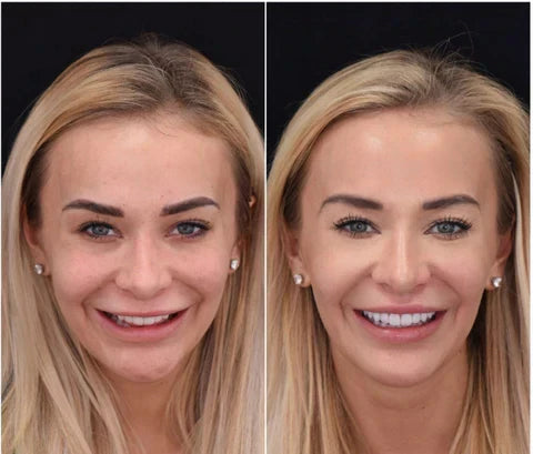 Riafu – Snap-On Veneers Set for Upper & Lower Teeth with Custom Fit | Removable Solution for a Natural-Looking Smile