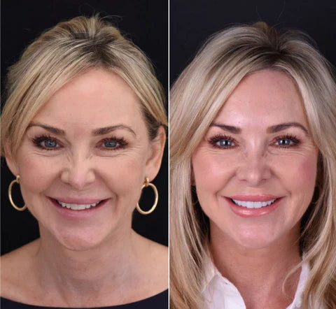 Riafu – Snap-On Veneers Set for Upper & Lower Teeth with Custom Fit | Removable Solution for a Natural-Looking Smile